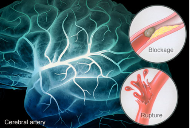 Đột quỵ – bạn đã biết những gì về căn bệnh nguy hiểm này??